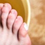 PENCEGAHAN DAN PENGOBATAN AMPUH ATASI CLAVUS (MATA IKAN)