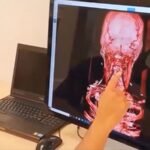 PROFESOR ITS KEMBANGKAN SISTEM STEREOTAKTIK UNTUK DUKUNG BEDAH SARAF OTAK