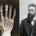 TERPAPAR SINAR X-RAY TERUS MENERUS SEBABKAN KERUSAKAN PERMANEN PADA ANGGOTA TUBUH