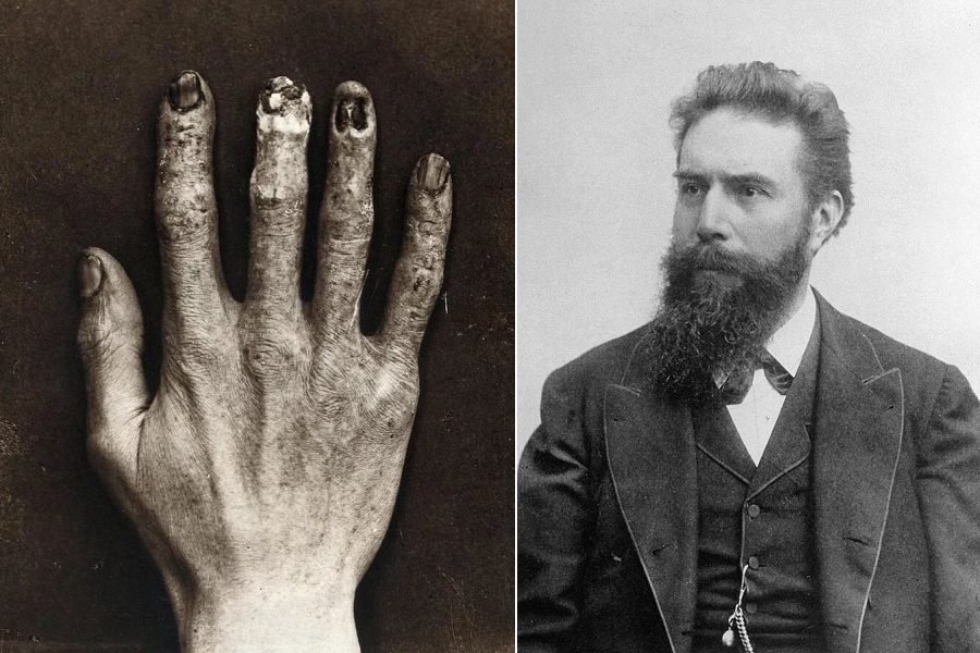 TERPAPAR SINAR X-RAY TERUS MENERUS SEBABKAN KERUSAKAN PERMANEN PADA ANGGOTA TUBUH