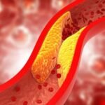 6 TANDA PEMBULUH DARAH MULAI TERSUMBAT