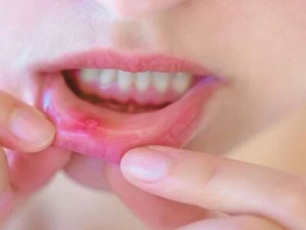 5 CARA MUDAH MENCEGAH SARIAWAN SAAT BERPUASA