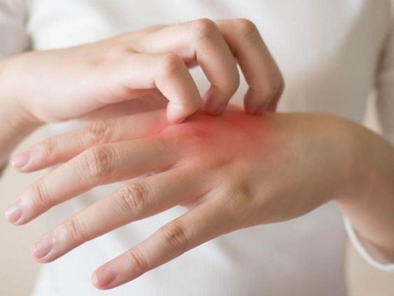 5 HAL SEPELE YANG DAPAT MEMICU ALERGI, HATI-HATI!